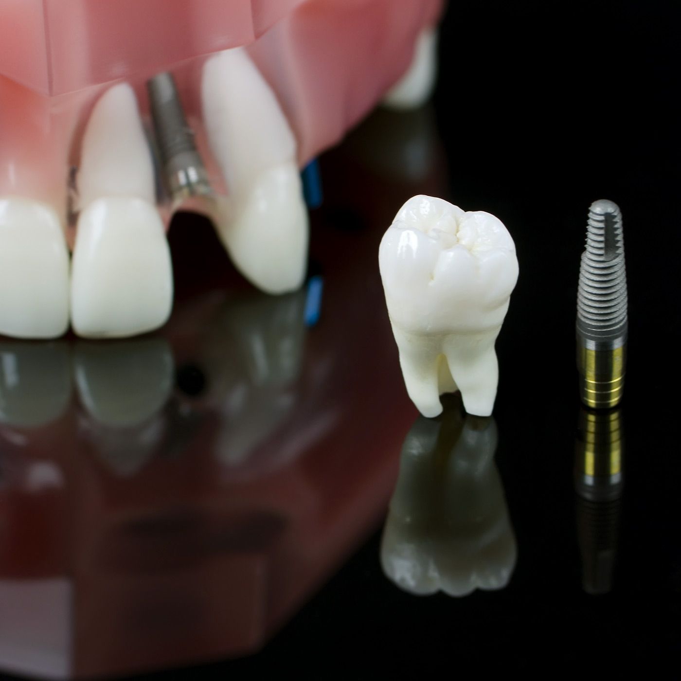 Model of jaw, tooth and implant