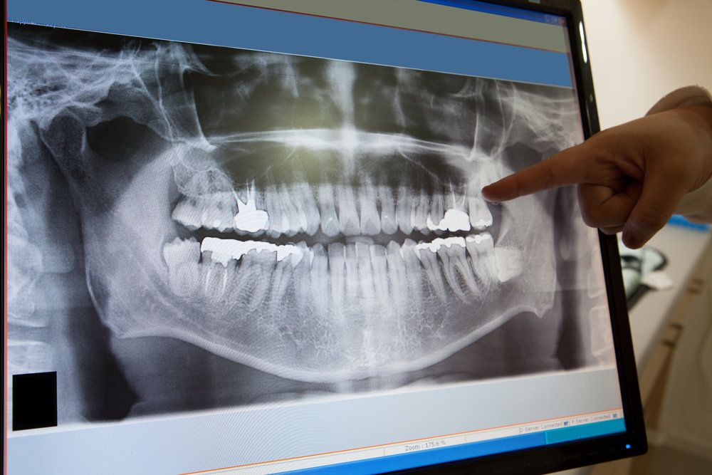 Photo of a dental x-ray