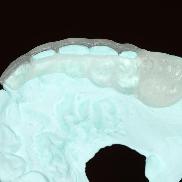 digital model of a bite